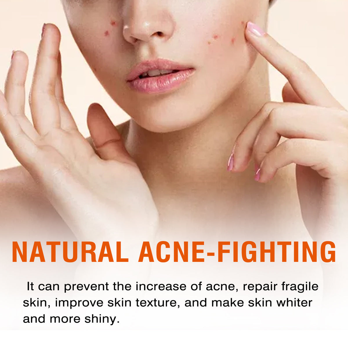 🔥Acne Mark Repair Cream — Specially formulated for teenagers and adults with sensitive skin; effectively fades acne marks and clears blemishes. Fragrance-free and paraben-free.😮