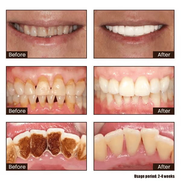 🔥BUY 1 FREE 1🔥New 7-Pro Intensive Toothpaste | Upgraded Purple Formula with 7 Probiotics | Deep Enamel Repair & Long-Lasting Freshness#dealsforyoudays
