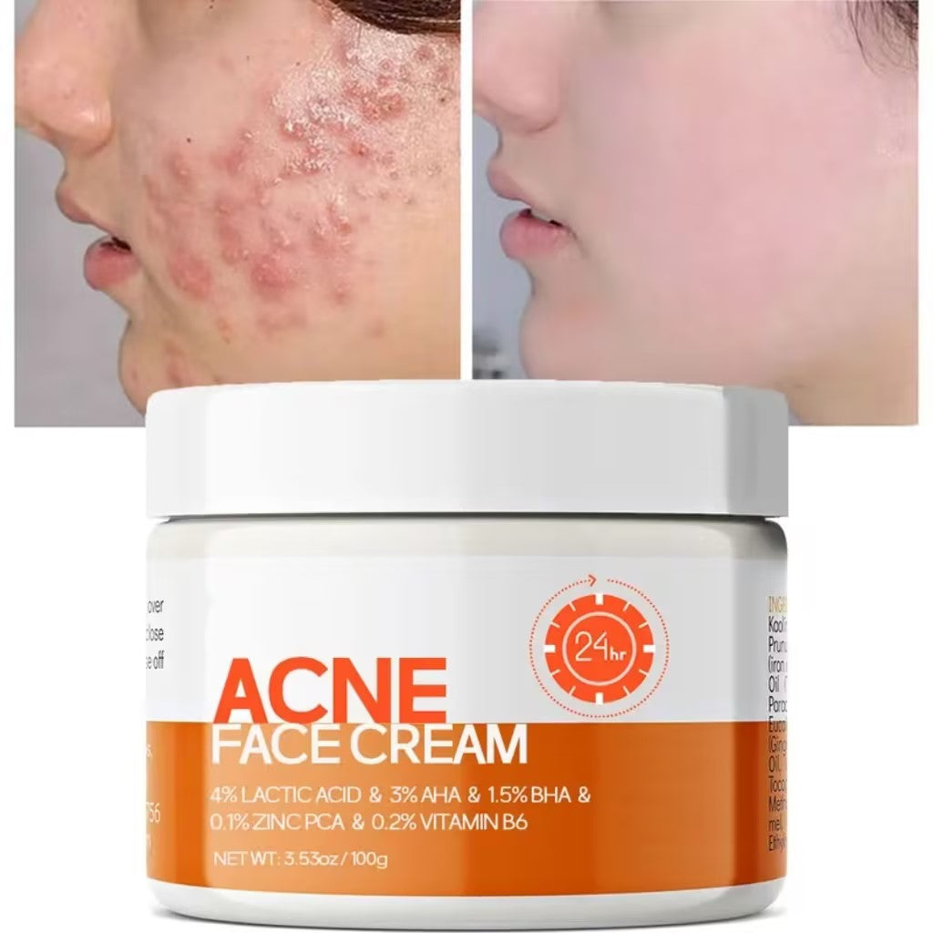 🔥Acne Mark Repair Cream — Specially formulated for teenagers and adults with sensitive skin; effectively fades acne marks and clears blemishes. Fragrance-free and paraben-free.😮