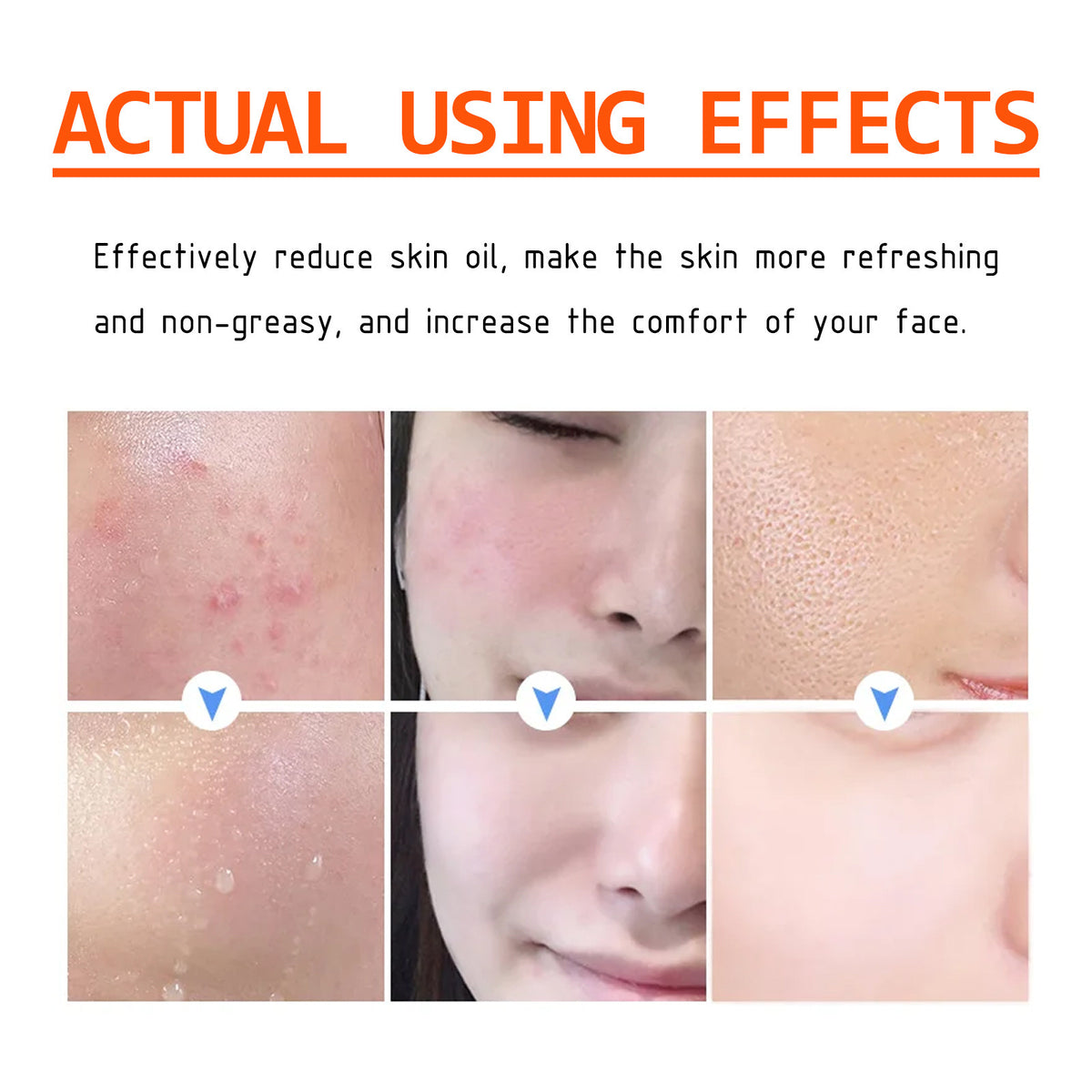 🔥Acne Mark Repair Cream — Specially formulated for teenagers and adults with sensitive skin; effectively fades acne marks and clears blemishes. Fragrance-free and paraben-free.😮