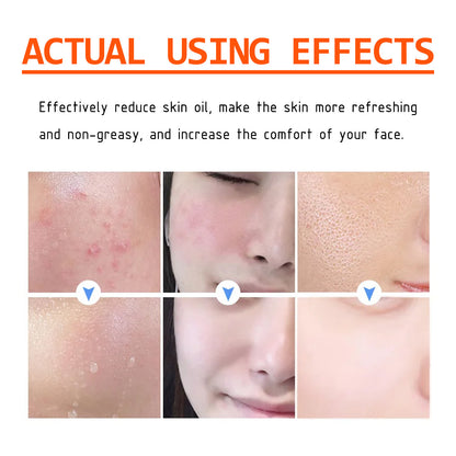 🔥Acne Mark Repair Cream — Specially formulated for teenagers and adults with sensitive skin; effectively fades acne marks and clears blemishes. Fragrance-free and paraben-free.😮